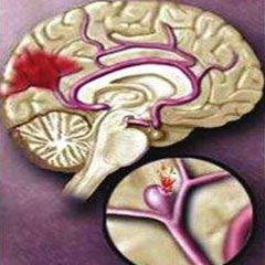 天氣驟變，經(jīng)顱多普勒廠家提醒您謹(jǐn)防心腦血管疾病突發(fā)