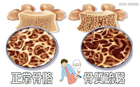 導(dǎo)致骨密度危險(xiǎn)因素有哪些