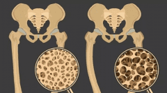 骨密度儀測定助您真正認(rèn)識骨密度