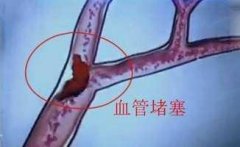 超聲經(jīng)顱多普勒：打個噴嚏竟能誘發(fā)腦梗?