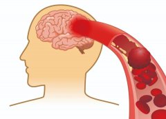 腦供血不足可檢查、可逆轉(zhuǎn)嗎